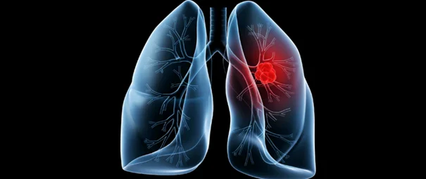 LungCancer 01_06_2021